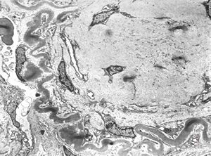 M,22y. | type II membranoproliferative glomerulonephritis M,22y. | type II membranoproliferative glomerulonephritis